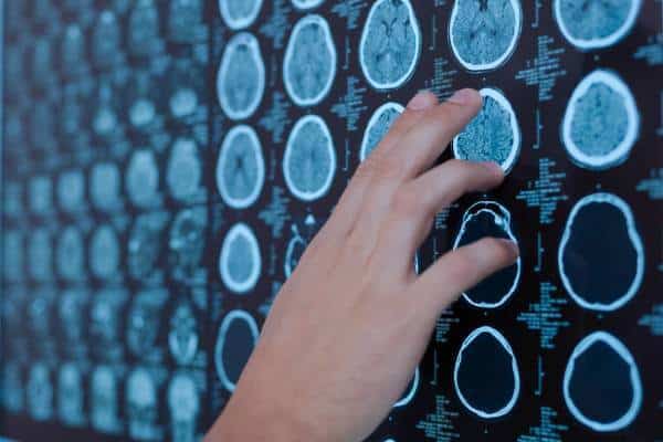 Medical professional examining brain MRI scans for tumour detection.