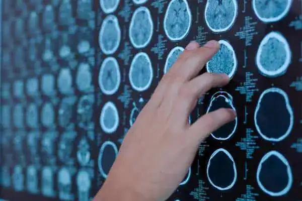 Glioma