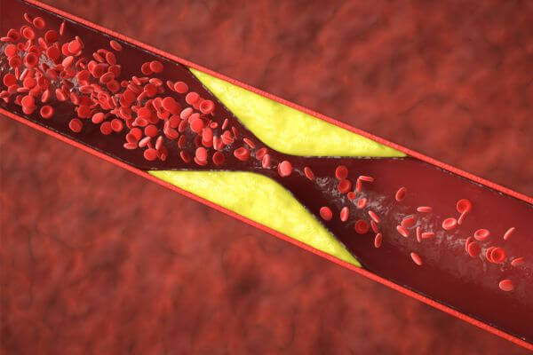 Cross-section of a blood vessel showing plaque buildup and blood flow.