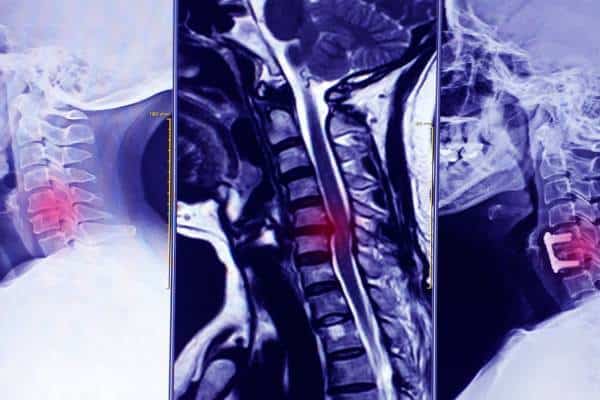 Detailed MRI scan of the cervical and thoracic spine for diagnosis.
