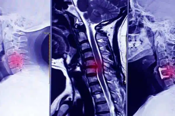 Detailed MRI images of the cervical and thoracic spine decompression