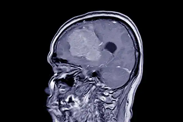 Meningioma Surgery Sydney