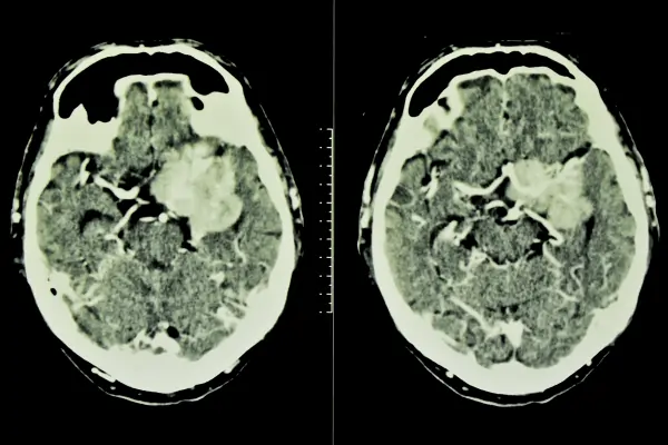 Meningioma Surgery