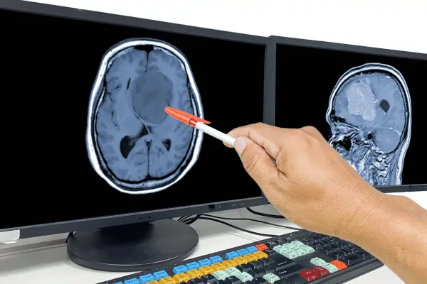 Sydney Meningioma Surgery